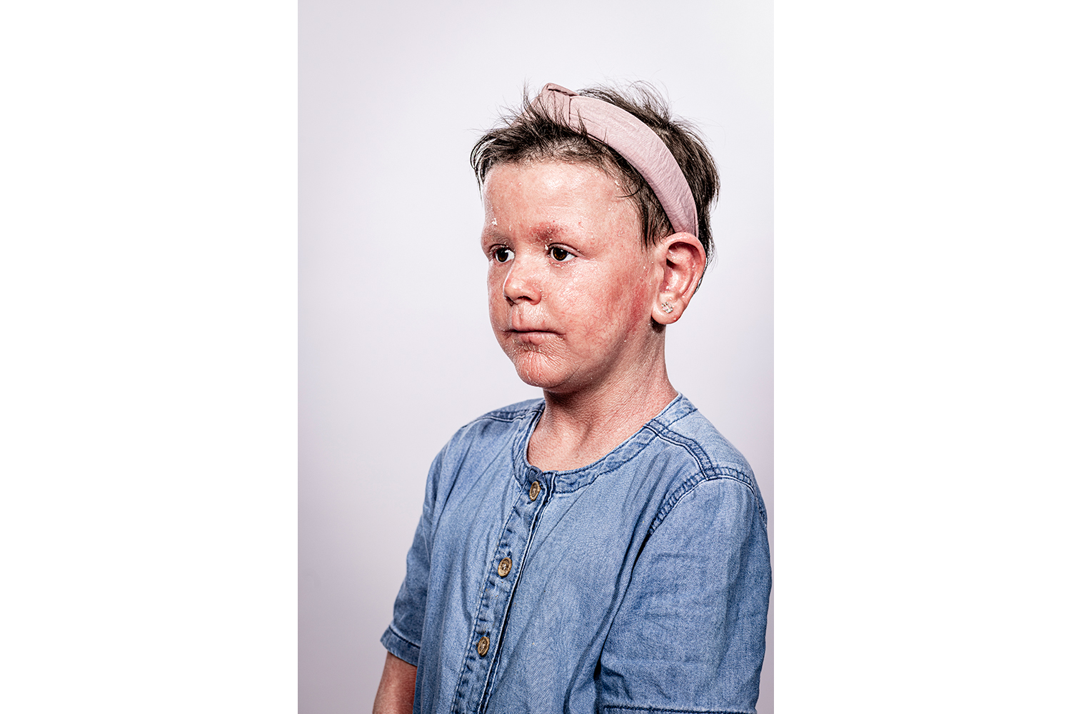 young child with ichthyosis
