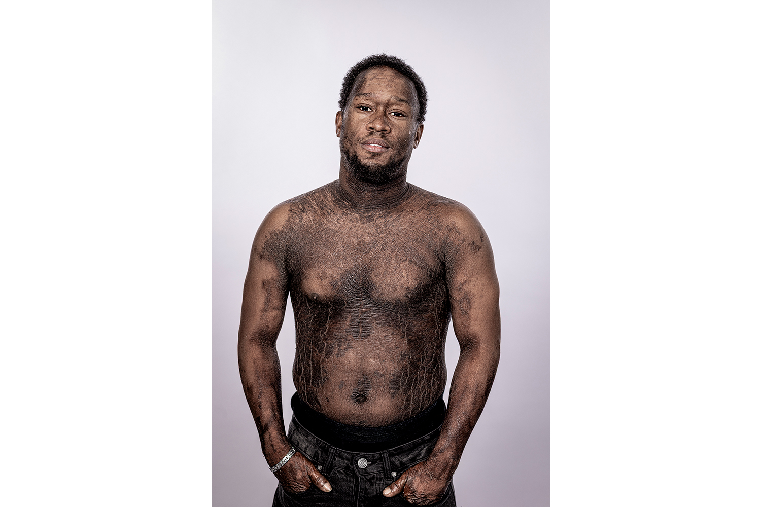 young black man with ichthyosis