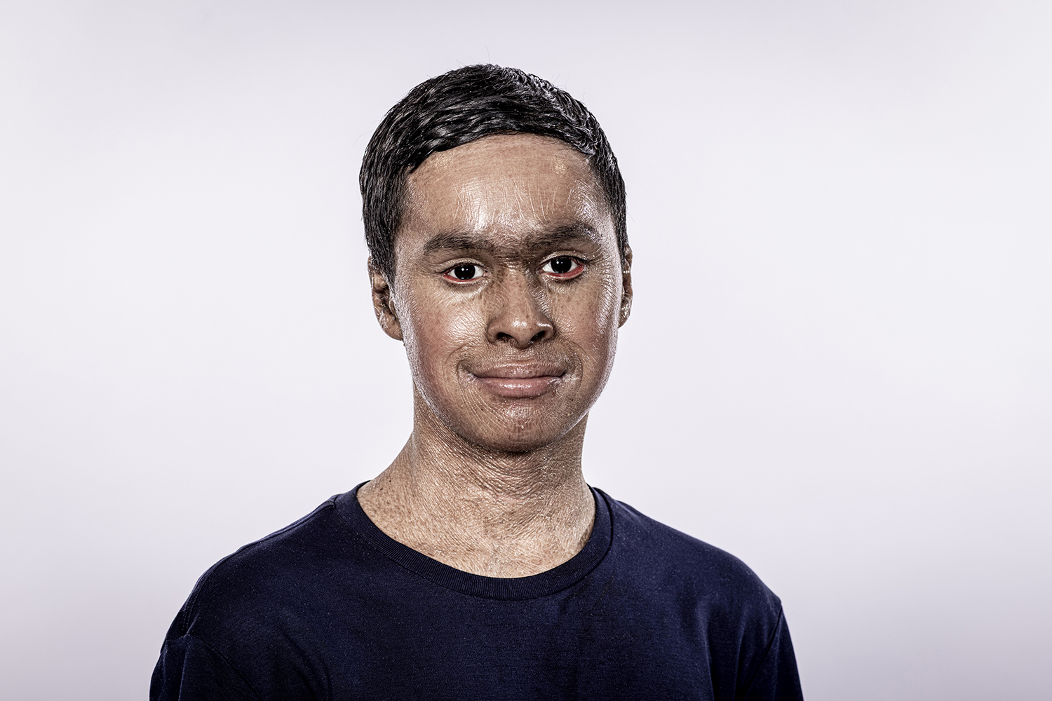 young asian boy with ichthyosis