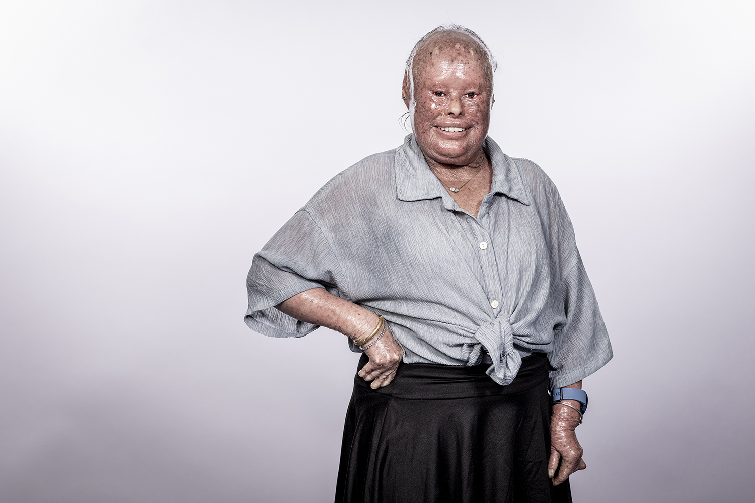 lady with ichthyosis